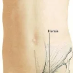 Hernia_-_Hydrocephalus_image216