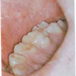 Malocclusion_-_Meningitis_image219